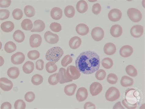 Cabot ring in hemolytic anemia