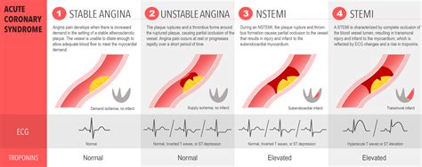 Acute Coronary Syndrome