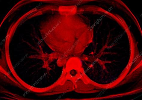 Normal lung, CT scan - Stock Image - F036/5128 - Science Photo Library