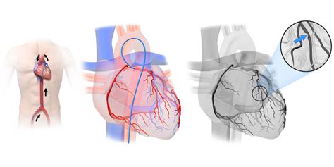 Coronary_Angiography - Central Georgia Heart Center