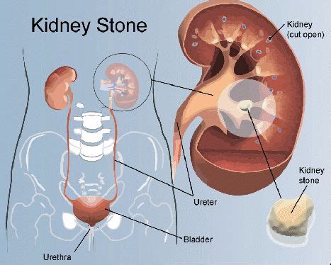 Renal Calculi | Renal Treatment Centers