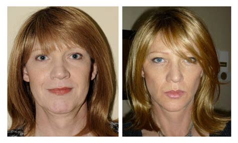 Facial Exercise Before and After - Facial Exercise Central