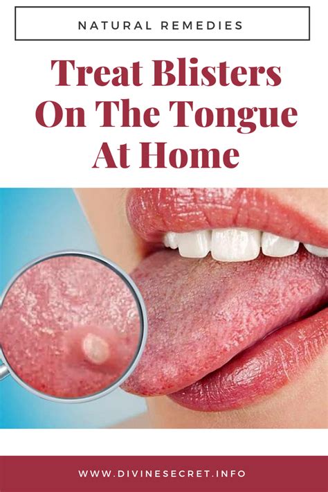 Treat blisters on the tongue at home | Natural remedies, Remedies ...