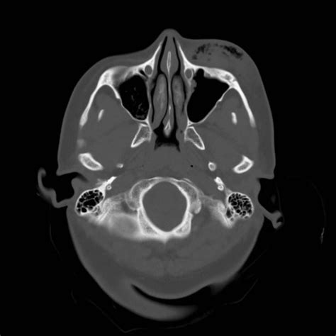 File:Traumatic pneumocranium, cribriform plate fracture and subarachnoid hemorrhage (Radiopaedia ...