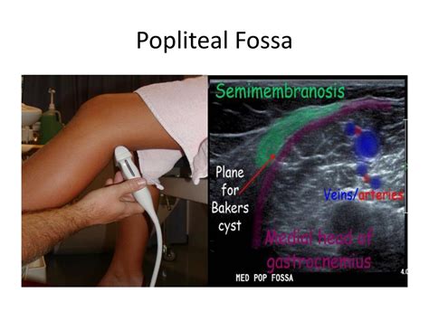 PPT - BASIC ULTRASOUND OF THE KNEE PowerPoint Presentation, free ...