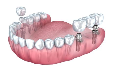 Dental Implant Cost Claremont | How Much Are Dental Implants