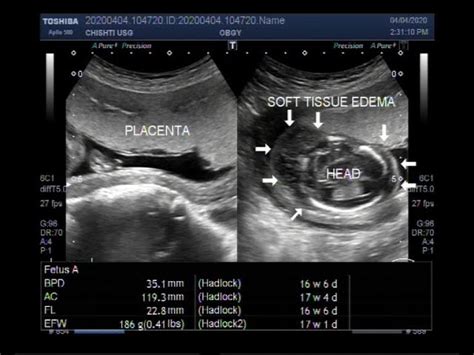 Hydrops Ultrasound