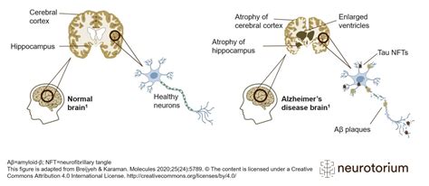 Alzheimer's disease brain with amyloid plaque and neurofibillary ...