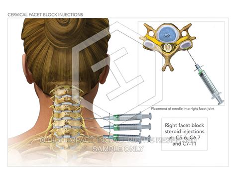 Image 09830_im02: Cervical Facet Block Injections Illustration