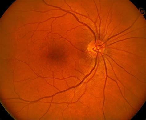 Discover the Magic of Retinal - Fundus Photography - Gazal Eye Care