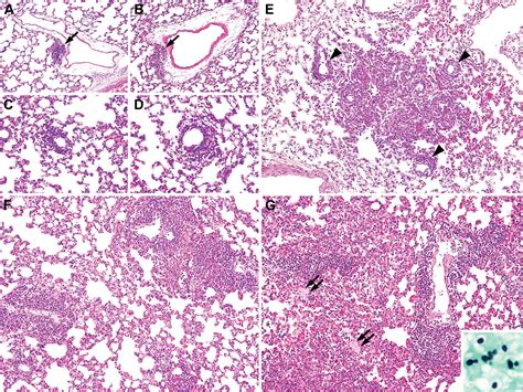 Histopathology of Pneumocystis carinii pneumonia in immunocompetent ...