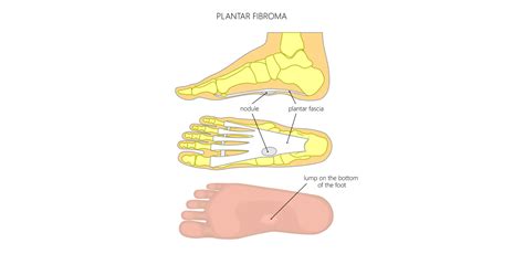 Plantar Fibroma: Causes, Symptoms & Treatment - Dr Foot Podiatry