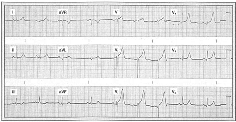 Figure 2 from Heart Murmur in a Football Player With a Normal ECG ...