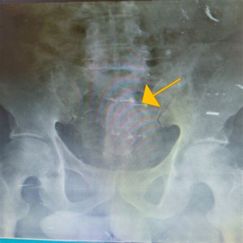 Normal retrograde urethrogram. | Download Scientific Diagram