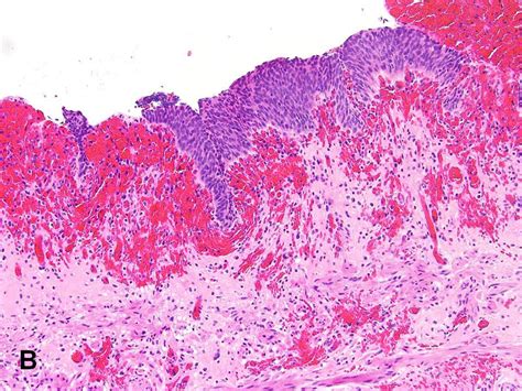 American Urological Association - Hemorrhagic Cystitis