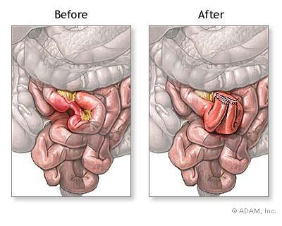 The New York Times > Health > Slide Show > Small Bowel Resection > Slide 6 of 6