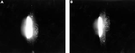 Corneal guttata associated with the corneal dystrophy resulting from a βig-h3 R124H mutation ...