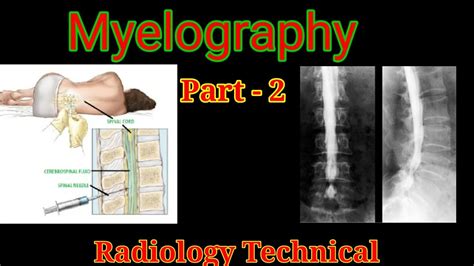 Myelography procedure # Part - 2 # Myelogram examination || By BL ...