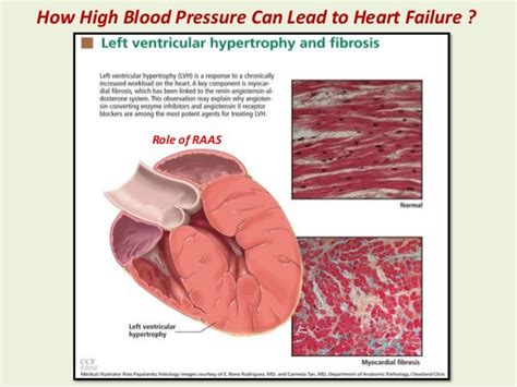 Hypertensive Heart Disease Causes Of | carfare.me 2019-2020