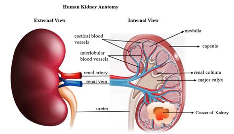 Diagram showing human kidney anatomy and Renal cell carcinoma developed ...