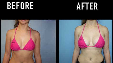 breast augmentation before and after natural looking