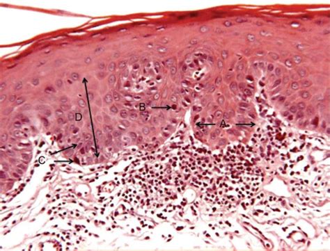 Erythroplakia Histopathology