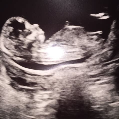 Confirmed boy and girl ultrasound scans a collection of boy and girl ...