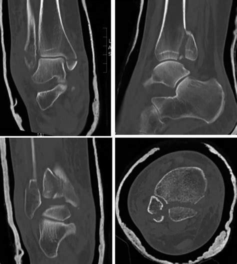 Trimalleolar fracture with computed tomography scan revealing details... | Download Scientific ...