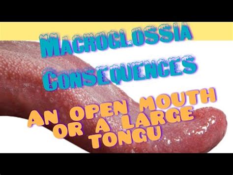 MACROGLOSSIA, Causes and management || Large Sized Tongue can badly ...