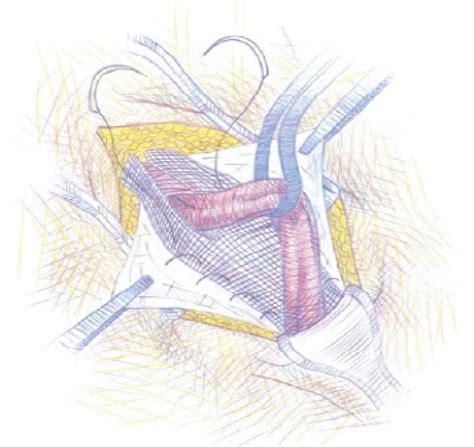 SciELO - Brasil - Assessment of postoperative risk of complications on inguinal hernioplasty and ...