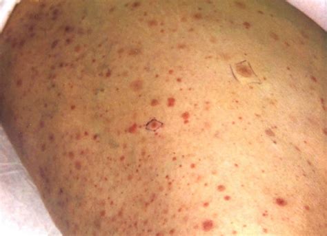 Petechiae definition, petechial rash causes, diagnosis & treatment