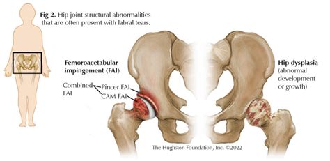 Hip Labral Tear - Hughston Clinic