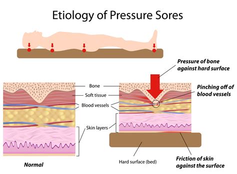 Pressure Ulcers (Bed Sores) | Health Life Media