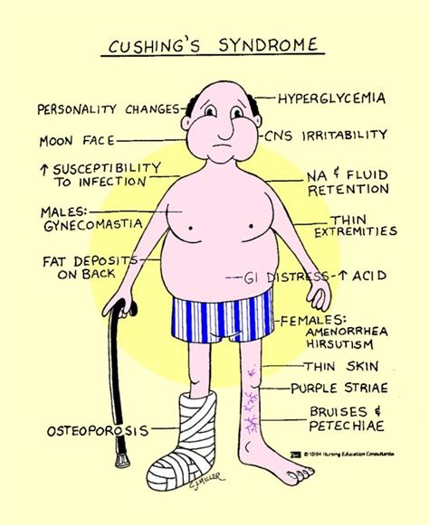 cushing syndrome | via julie stockton | Endocrine | Pinterest | Nclex