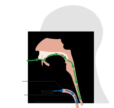 Laryngectomy | Tracheostomy Education