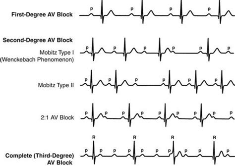 Second-Degree Heart Block: Symptoms, Causes, Treatment,, 59% OFF