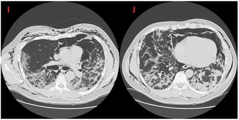 Spontaneous pneumomediastinum as a complication of COVID-19