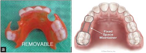 Best Functional & Lingual Arch Dental Space Maintainers Service in India