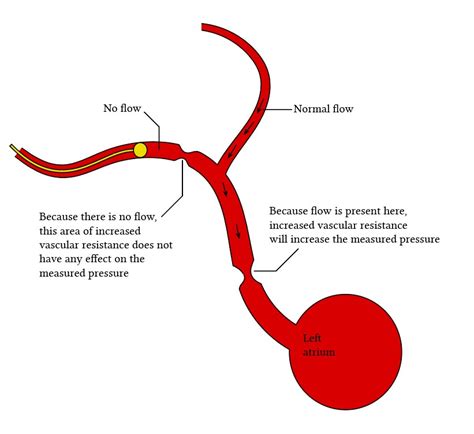 Physiology of pulmonary artery wedge pressure measurement | Deranged Physiology