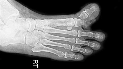 Xray Broken Foot