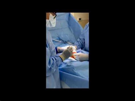 Spermatocelectomy - Full Surgery - YouTube