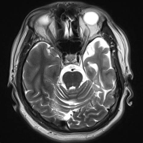 MRI scan, axial T2 sequence show left temporal lobe atrophy, with ...