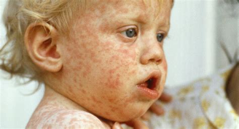 Measles Rash