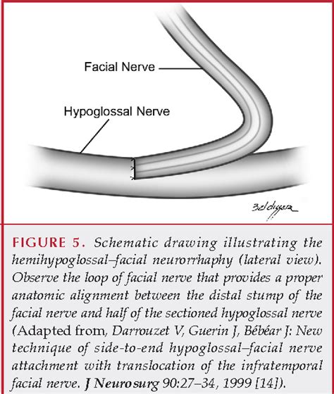 neurorrhaphy | Semantic Scholar