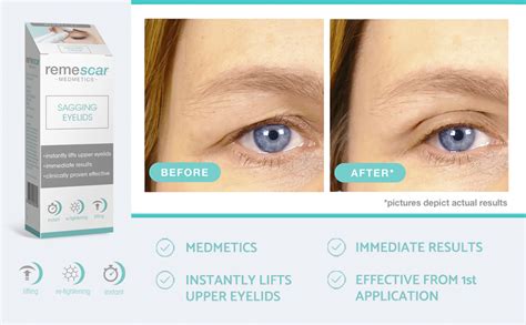 Lift Sagging Eyelids Instantly | lupon.gov.ph