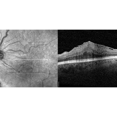 Macular Pucker for Hollywood, FL | Hollywood Retina Consultants | Board ...