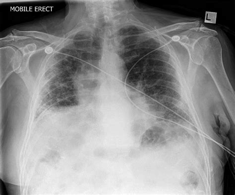 Interstitial Lung Disease X Ray