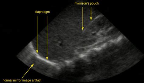 Morison's pouch - wikidoc