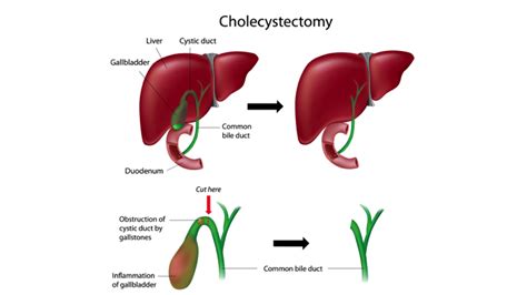 Gallbladder Removal by Laparoscopy (Laparoscopic Cholecystectomy)