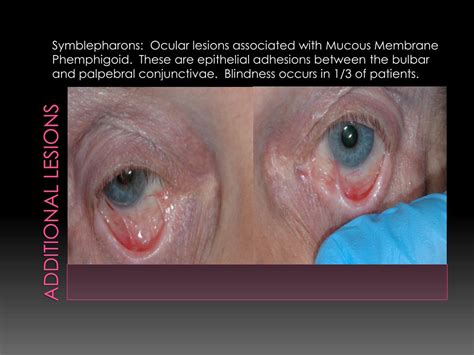 PPT - Benign Mucous Membrane Pemphigoid PowerPoint Presentation, free download - ID:1976272